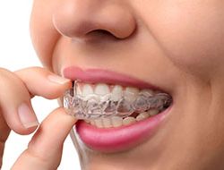 Invisalign